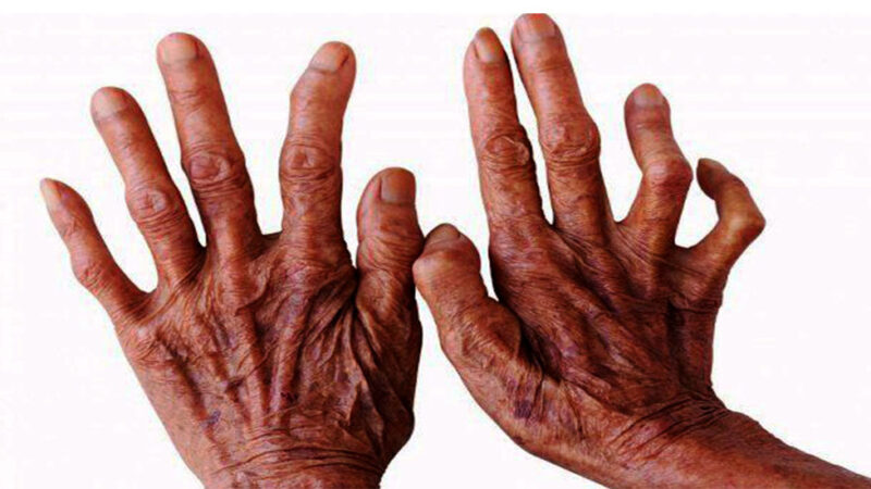 कुष्ठरोगबाट बालबालिका बढी प्रभावित हुँदै