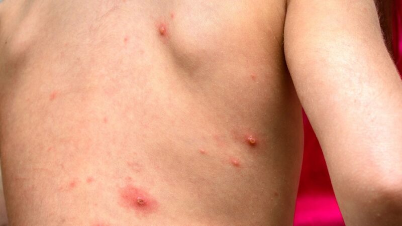 झापामा बढ्दै दादुराको प्रकोप