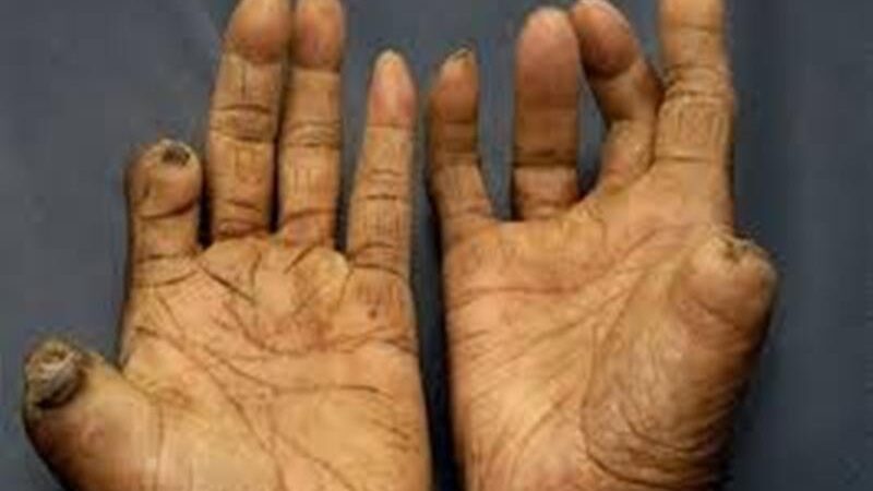 आज ७१औँ विश्व कुष्ठरोग दिवस : मधेस प्रदेशमा अधिक कुष्ठरोगी आज ७१औँ विश्व कुष्ठरोग दिवस : मधेस प्रदेशमा अधिक कुष्ठरोगी