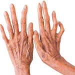 कुष्ठरोग नियन्त्रण चुनौती, मधेसका ४५ पालिका कुष्ठरोगमुक्त