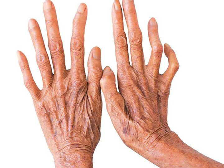 चितवनमा १८ जनामा कुष्ठरोगको सङ्क्रमण « रिपोर्टर्स नेपाल