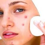 १० प्रभावकारी घरेलु उपाय डन्डिफोर नियन्त्रण गर्न