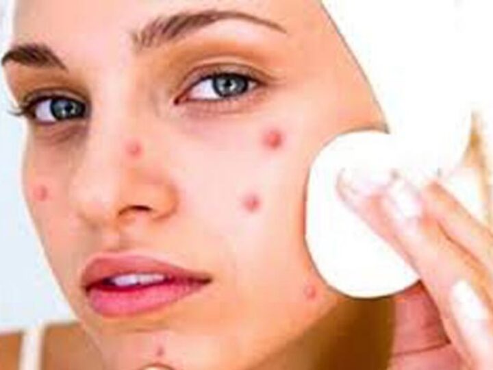 १० प्रभावकारी घरेलु उपाय डन्डिफोर नियन्त्रण गर्न