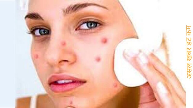 १० प्रभावकारी घरेलु उपाय डन्डिफोर नियन्त्रण गर्न