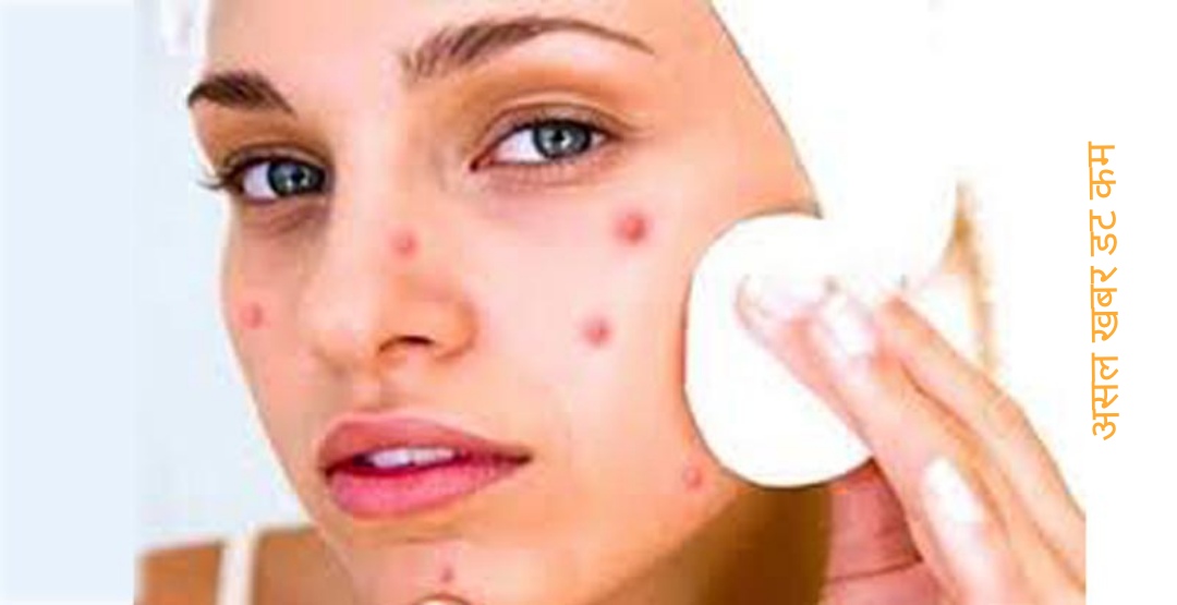 १० प्रभावकारी घरेलु उपाय डन्डिफोर नियन्त्रण गर्न १० प्रभावकारी घरेलु उपाय डन्डिफोर नियन्त्रण गर्न