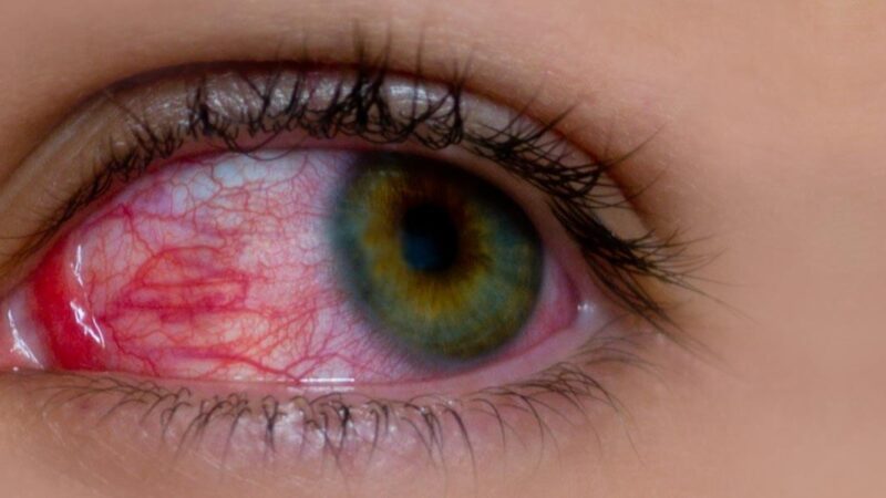 नसर्ने रोगले आँखाको समस्या बढाउँदै « रिपोर्टर्स नेपाल नसर्ने रोगले आँखाको समस्या बढाउँदै « रिपोर्टर्स नेपाल