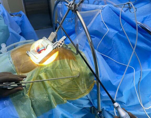 प्रा.डा. भट्टराईको अगुवाईमा नेपालमा पहिलोपटक एमआईसीएस प्रविधिबाट जन्मजात मुटुमा प्वाल भएको विरामीको ओपन हार्ट सर्जरी सम्पन्न