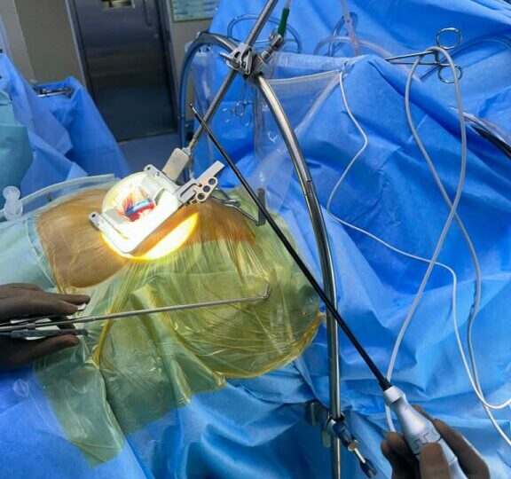 प्रा.डा. भट्टराईको अगुवाईमा नेपालमा पहिलोपटक एमआईसीएस प्रविधिबाट जन्मजात मुटुमा प्वाल भएको विरामीको ओपन हार्ट सर्जरी सम्पन्न