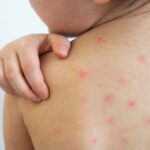 दुई महिनापछि ढोरपाटनमा दादुरा सङ्क्रमण रोकथाम