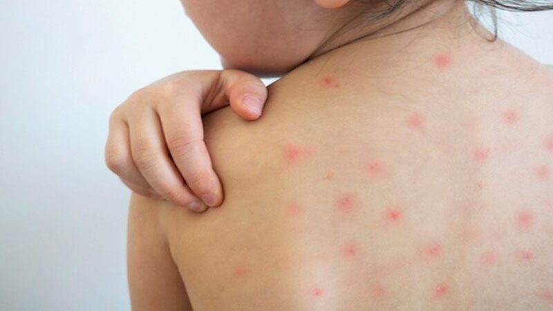 दुई महिनापछि ढोरपाटनमा दादुरा सङ्क्रमण रोकथाम