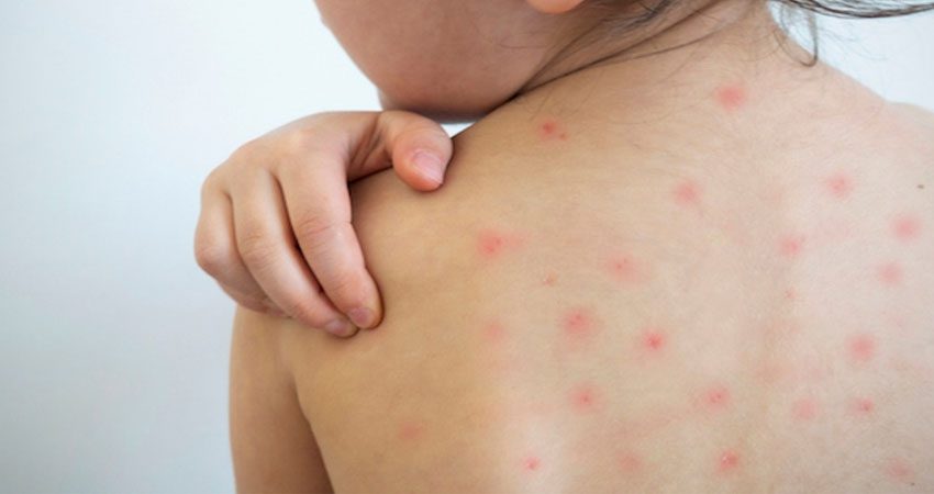 दुई महिनापछि ढोरपाटनमा दादुरा सङ्क्रमण रोकथाम