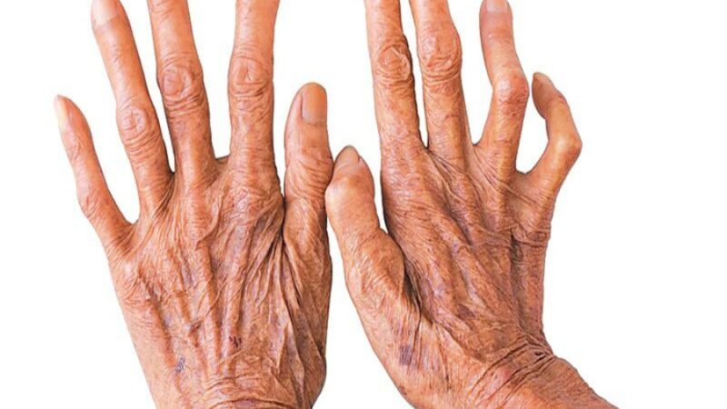 बाँकेमा १९३ कुष्ठरोगी « रिपोर्टर्स नेपाल